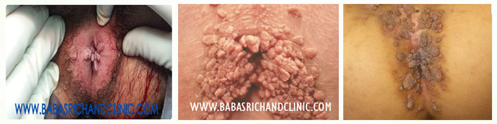 Genital Warts Pictures | HPV Photos in Men and Women